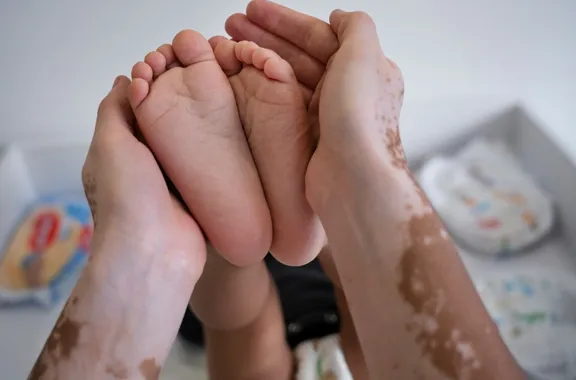 Vitiligo